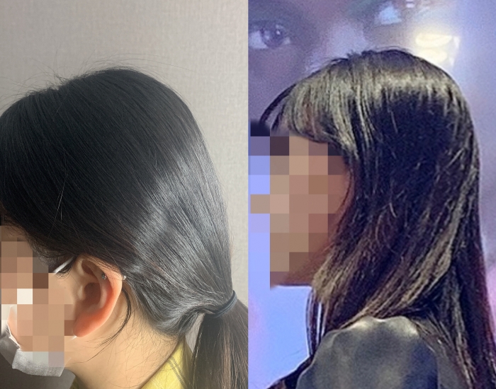 뒤통수 필러 후기