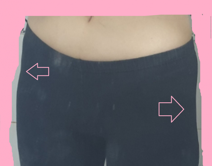 힙딥필러맞고왓어요! 2주차 후기