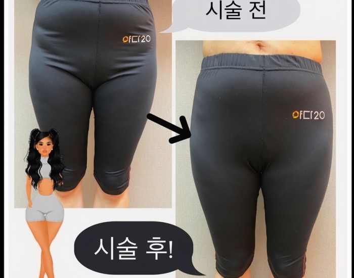 힙딥필러~~ 효과 짱!! 