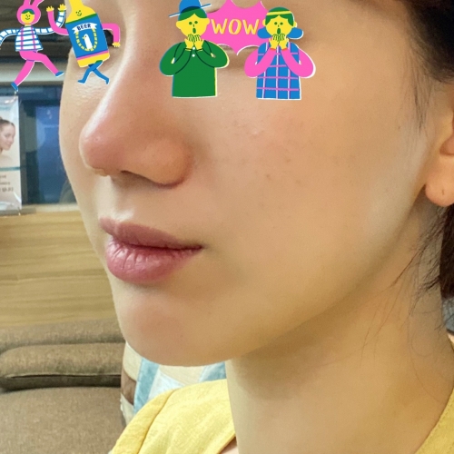 코필러 맞고 왔어요!
