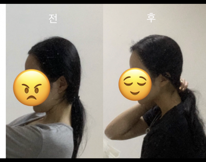 두상필러 후기