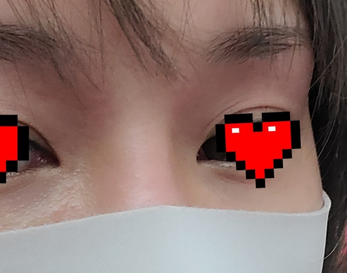 눈꺼풀 필러 후기