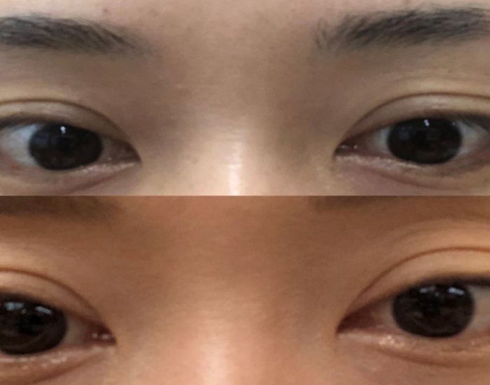 눈꺼풀 필러 후기입니다. 