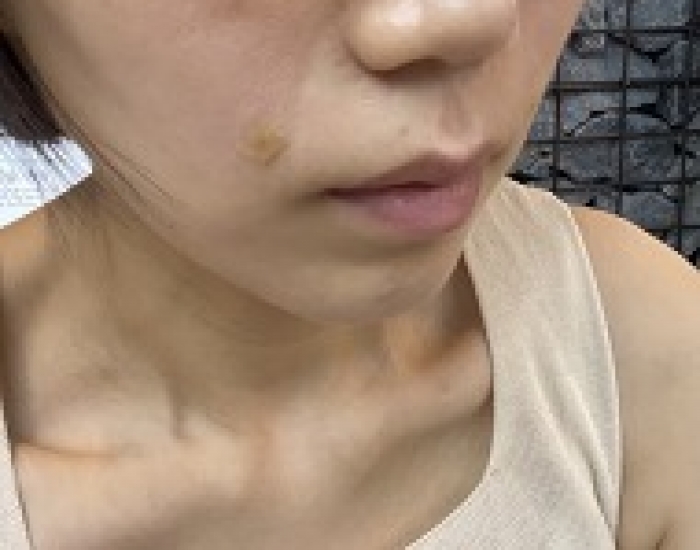 팔자필러 시술 했습니다.