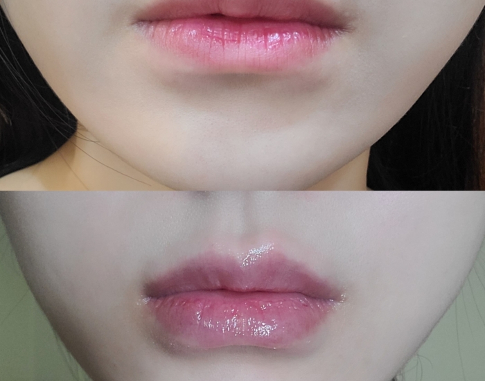 입술필러후기