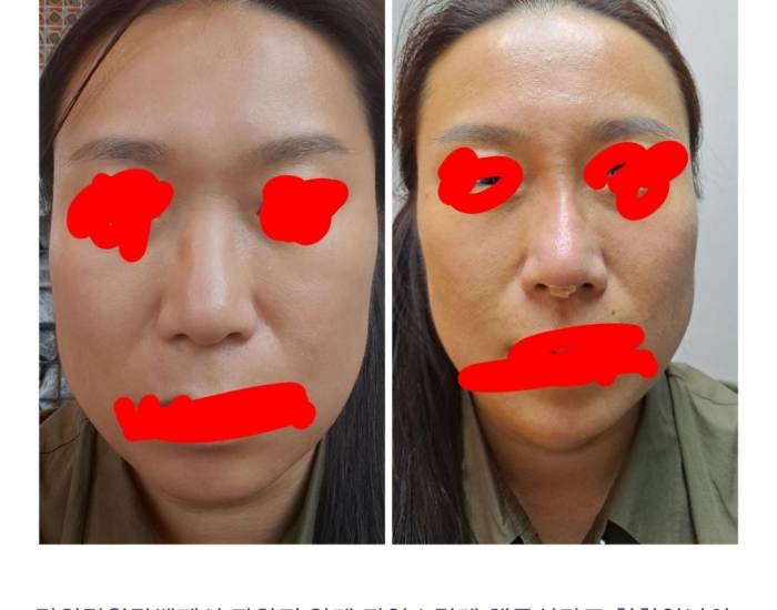 코 필러 시술 받았어요~^^