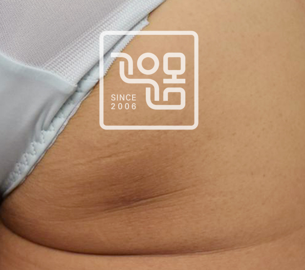 전후이미지