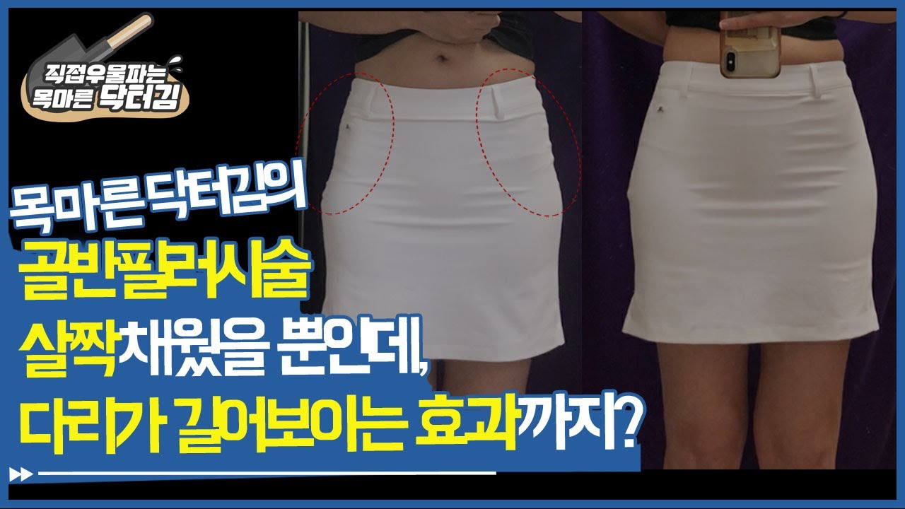 골반 힙딥필러(hip-dip) 시술 전후  살짝 채웠을뿐인데 다리가 길어보이는 효과까지?!