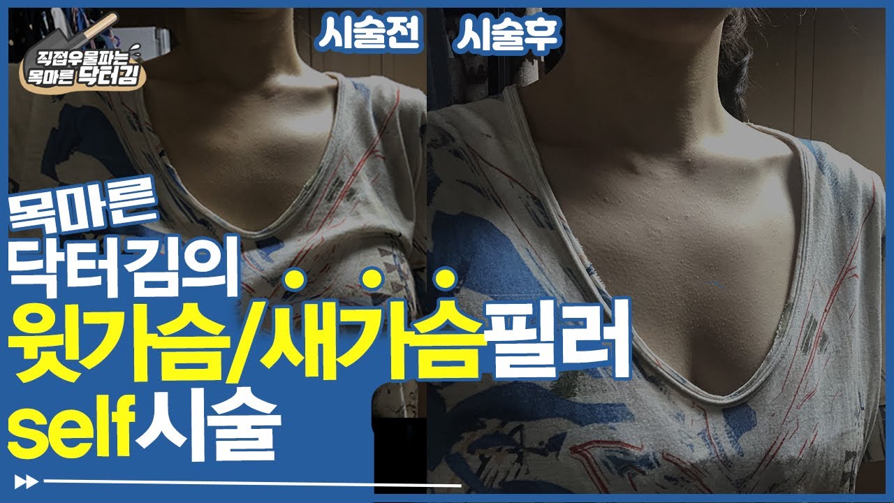 목마른닥터김 셀프 리얼 시술기