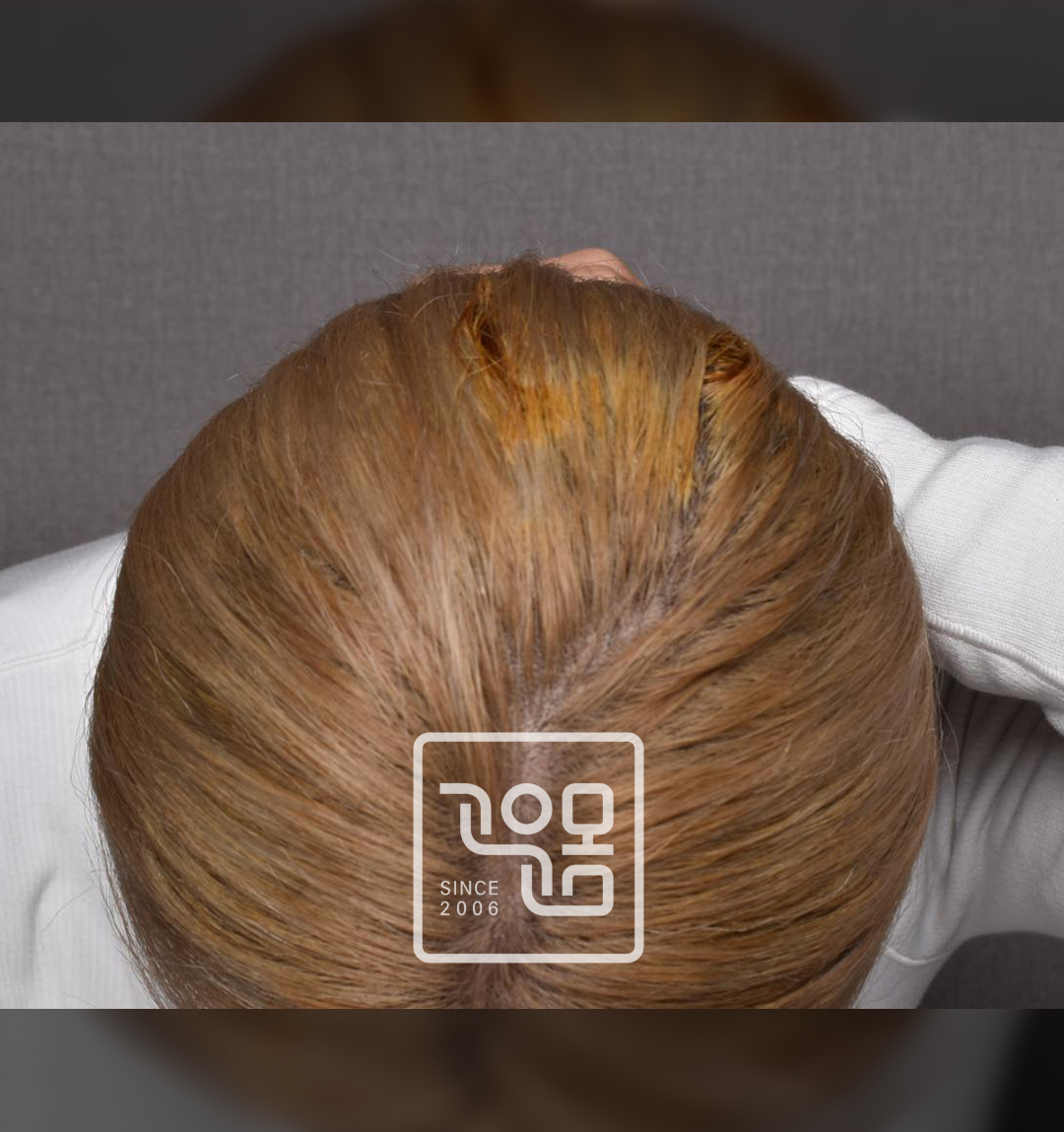전후이미지