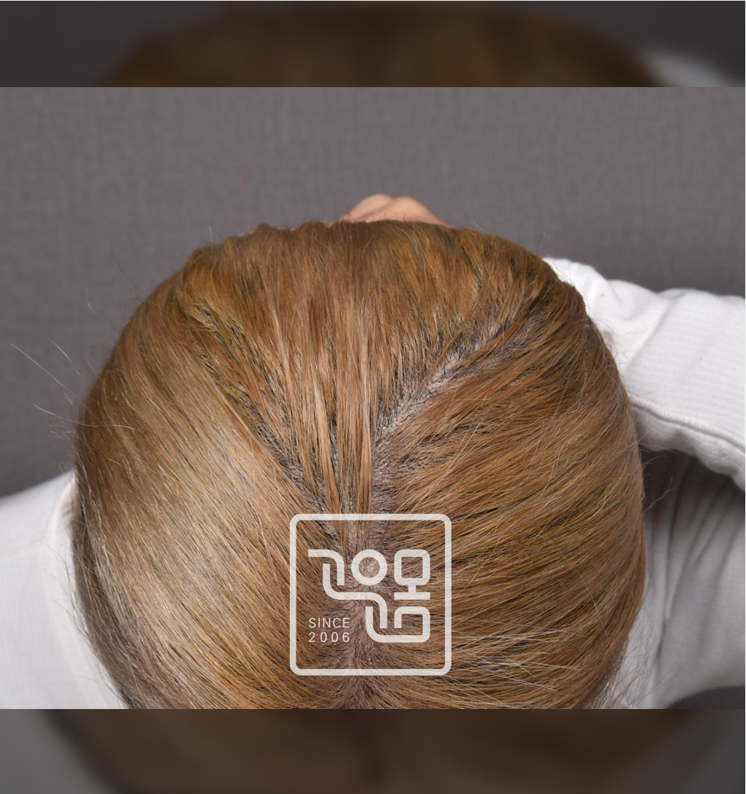 전후이미지