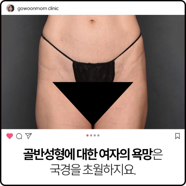 골반성형에 대한 여자의 욕망은 국경을 초월하지요.