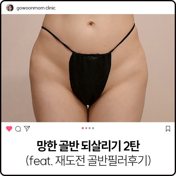 망한 골반 되살리기 2탄 (feat. 재도전 골반필러후기)