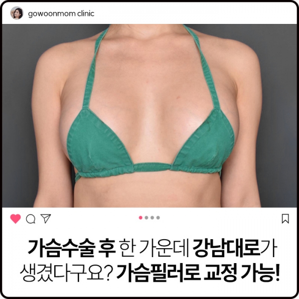 가슴수술 후 한 가운데 강남대로가 생겼다구요? 가슴필러로 교정 가능!