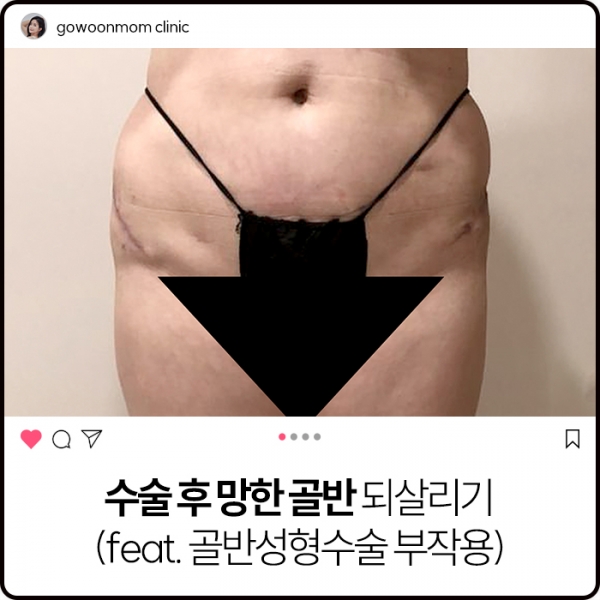 수술 후 망한 골반 되살리기 (feat. 골반성형수술 부작용)