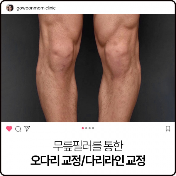 무릎필러를 통한 오다리 교정/다리라인 교정