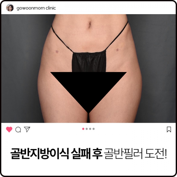 골반지방이식 실패 후 골반필러 도전!