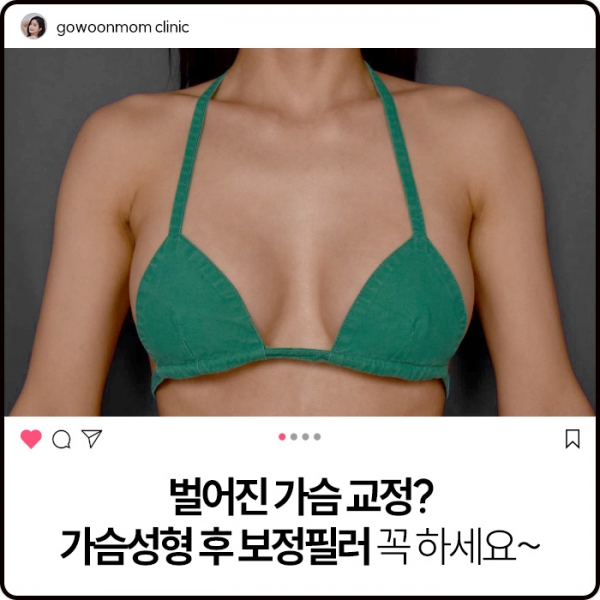 벌어진 가슴 교정? 가슴성형 후 보정필러 꼭 하세요~