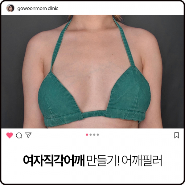 여자직각어깨 만들기! 어깨필러