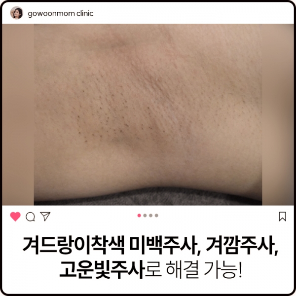 겨드랑이착색 치료 미백주사 겨깜주사로 해결 가능!"겨드랑이 그거 누가본다고?!"