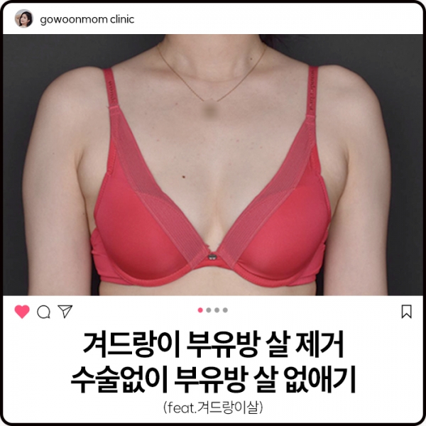 겨드랑이부유방제거 수술없애 부유방 없애기(feat.겨드랑이살)