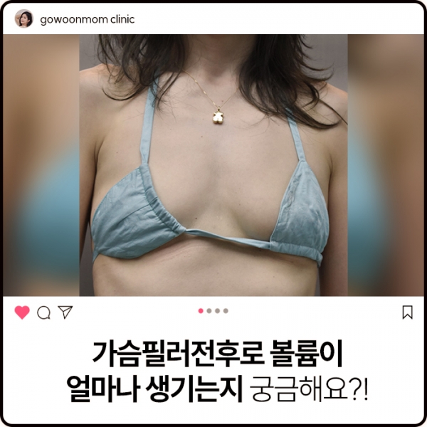 가슴필러전후 로 볼륨이 어느 정도 생기는지 궁금한 분들을 위한 포스팅! 가슴필러로 볼륨업 뿜뿜~