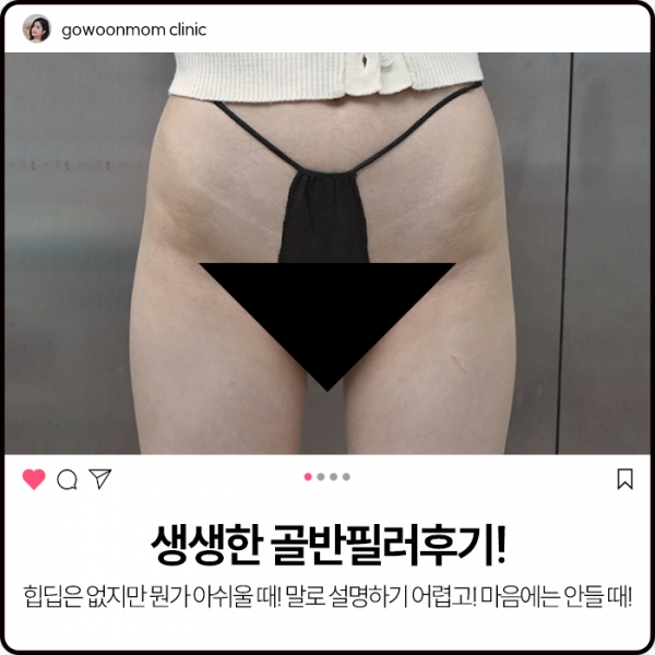 생생한 골반필러후기! 힙딥은 없지만 뭔가 아쉬운데... 말로 설명할 수는 없고... 근데 마음에는 안 들고...