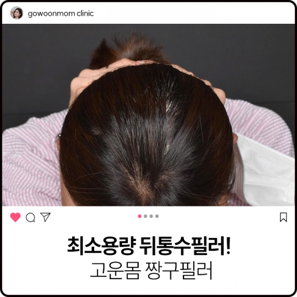 최소용량 뒤통수필러! 바로 짱구필러