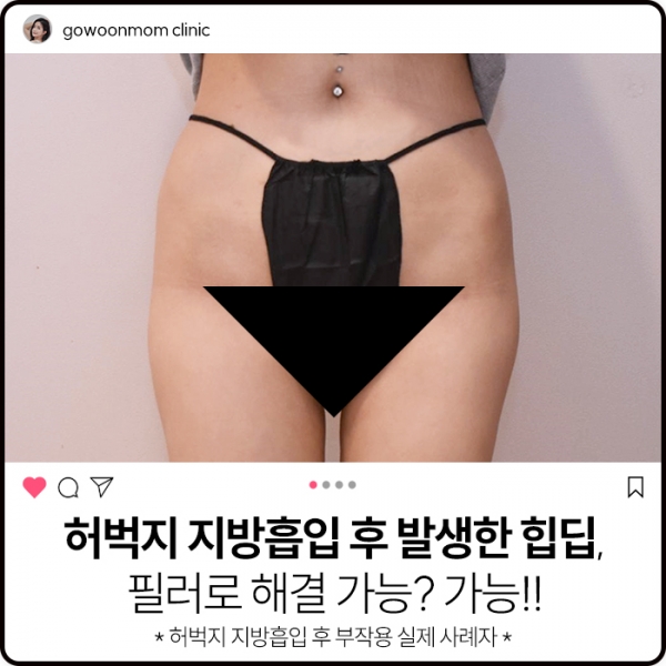 허벅지지방흡입부작용: 지방흡입수술 후 힙딥 발생