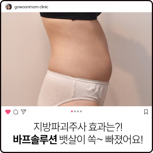 지방파괴주사효과는? 뱃살이 쏙~ 빠졌어요! 바프솔루션