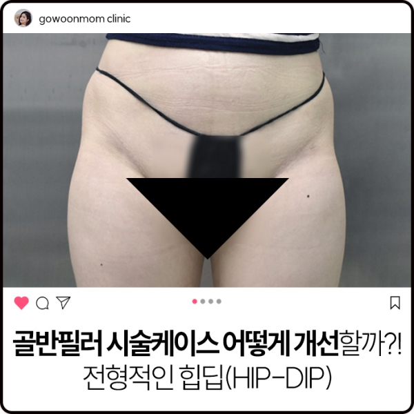 골반필러 시술케이스 어떻게 개선할까?!전형적인 힙딥(hipdip)