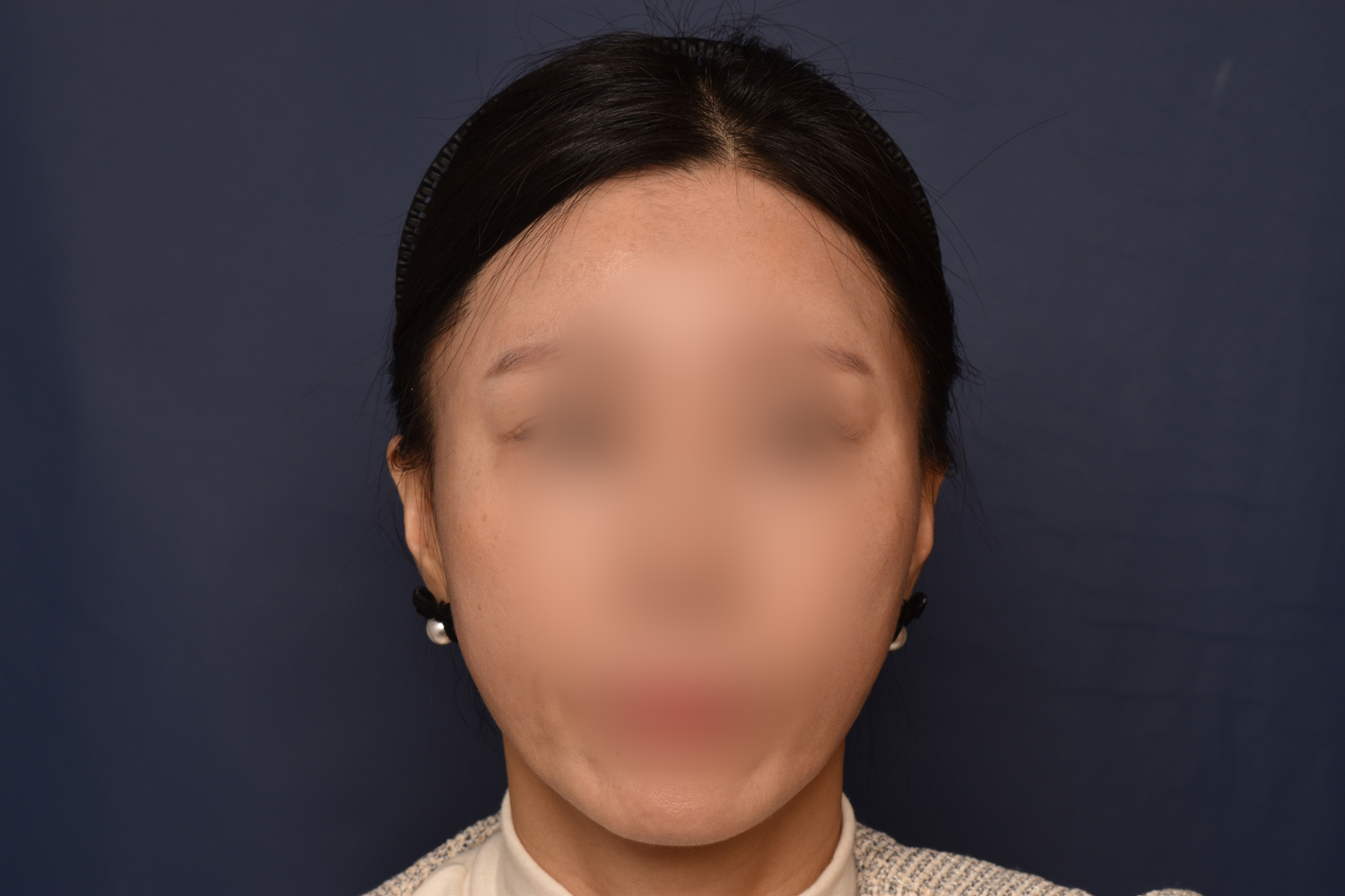 전후이미지