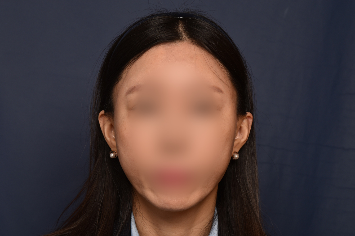 전후이미지