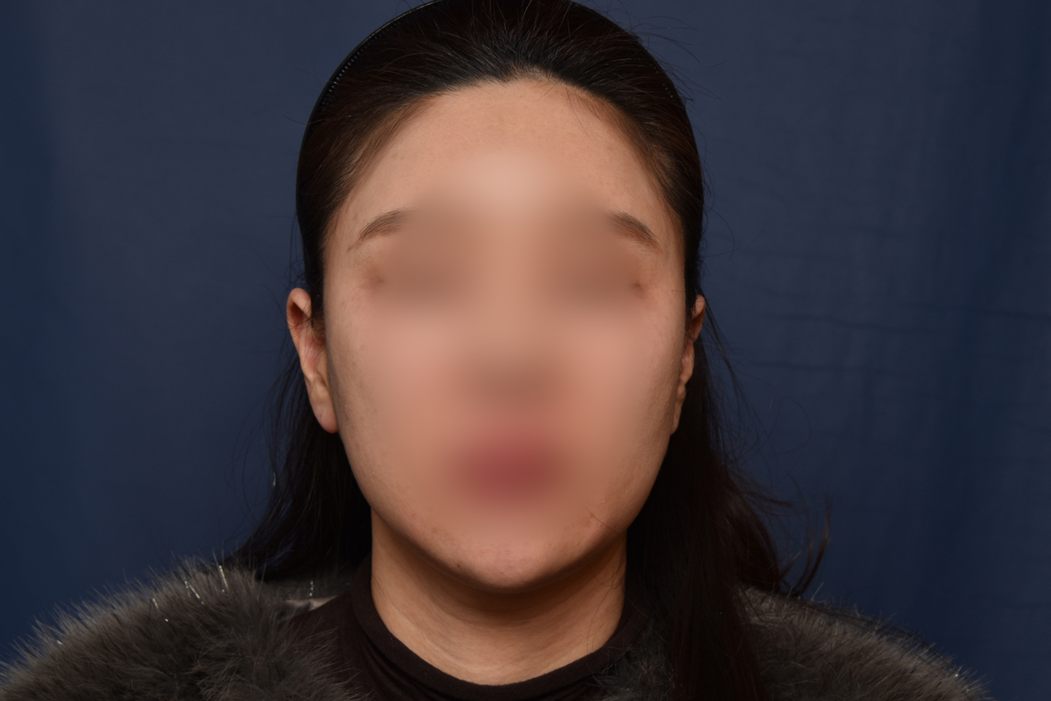전후이미지