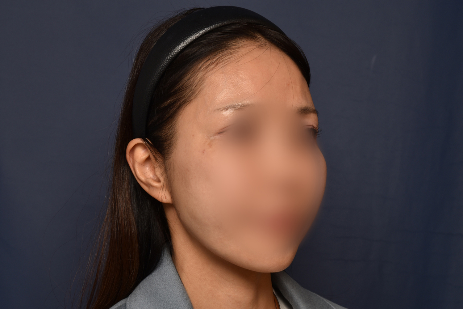 전후이미지