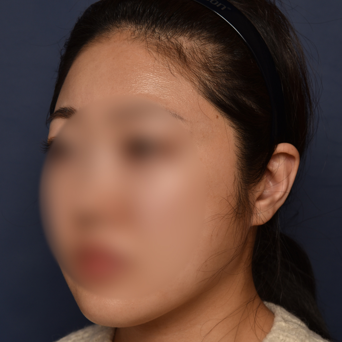 전후이미지