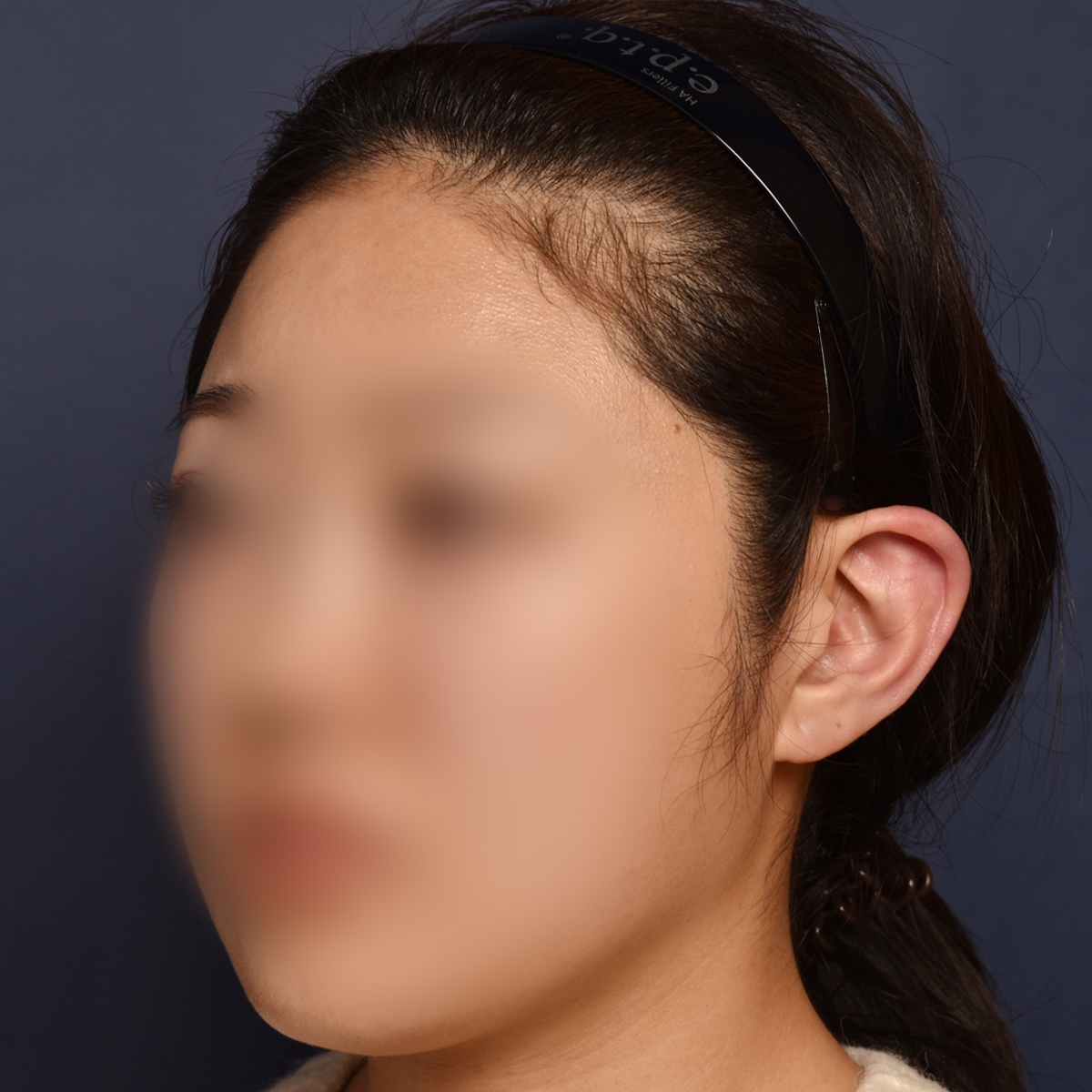 전후이미지