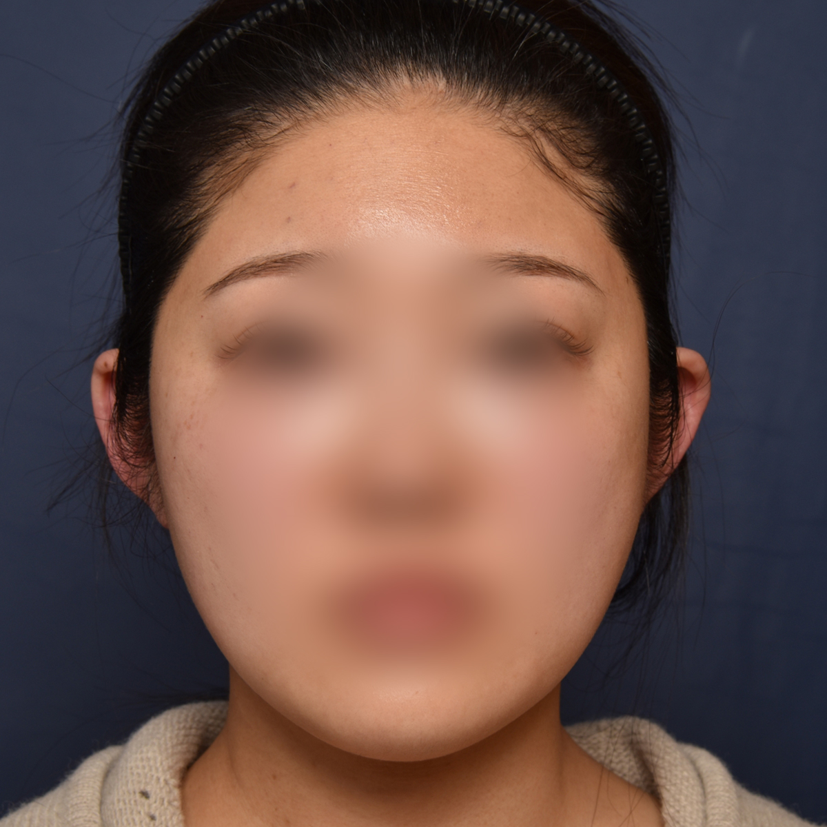 전후이미지