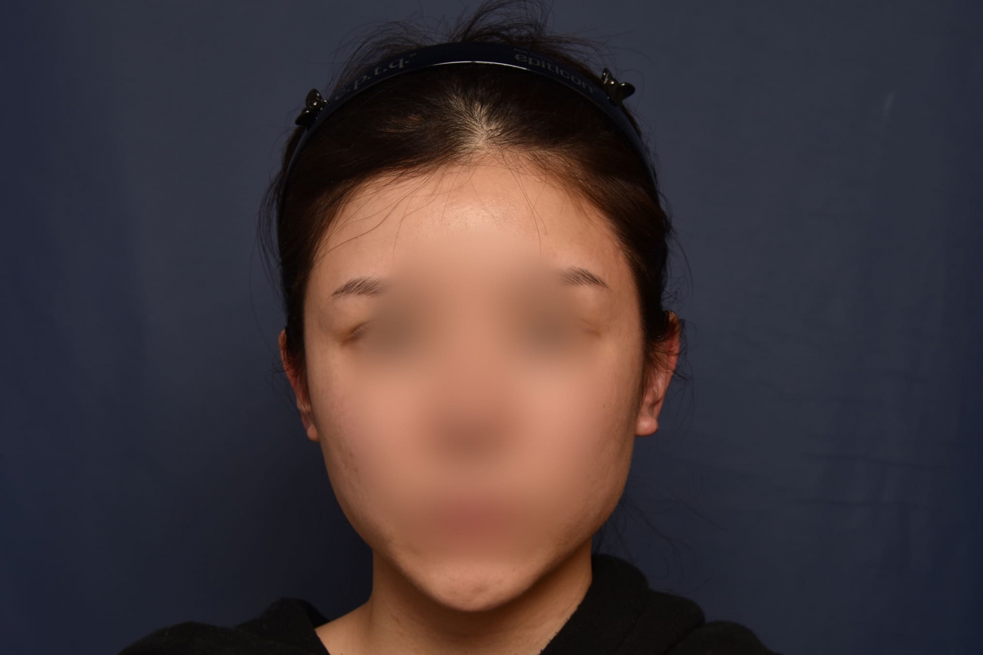 전후이미지