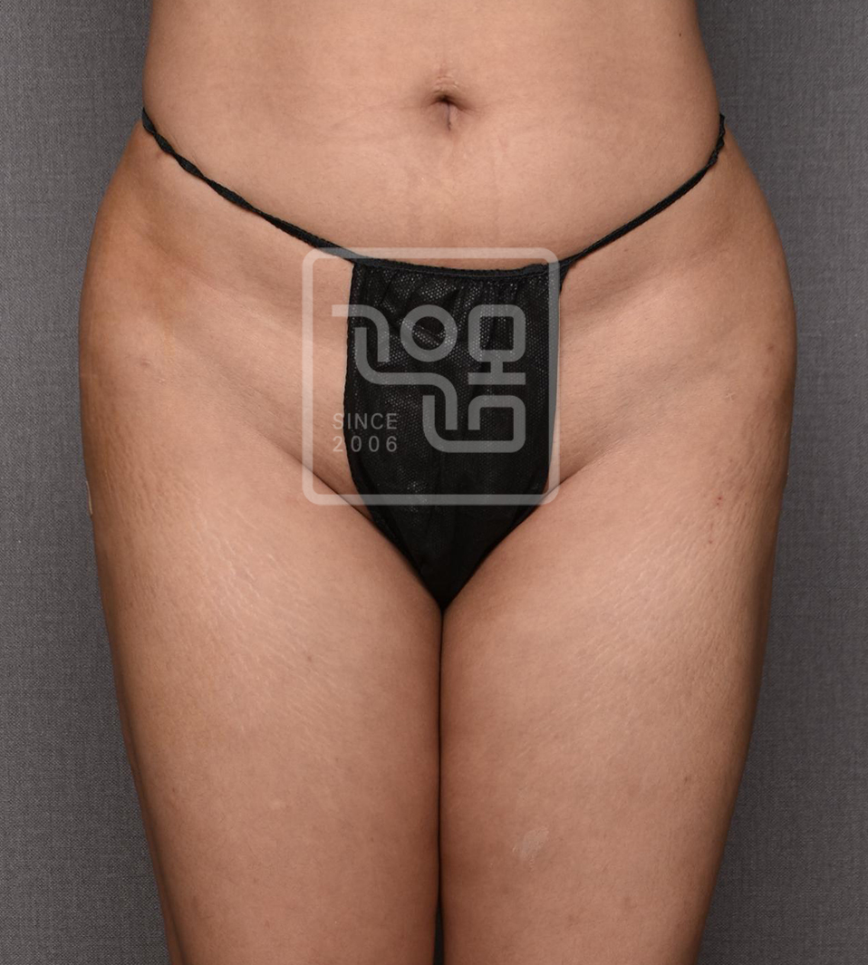 전후이미지