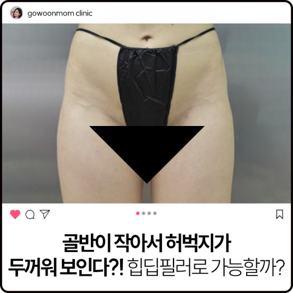 골반이 작아서 허벅지가 두꺼워 보인다! 힙딥필러로 가능할까?
