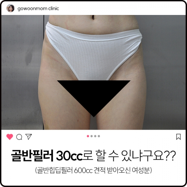 골반필러 30cc로 할 수 있냐구요???(골반힙딥필러600cc견적 받아오신 여성분)