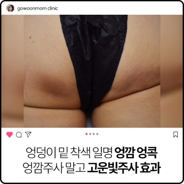 엉덩이 밑 착색 일명 엉깜 엉콕 _  엉깜주사 말고 고운빛주사 효과 