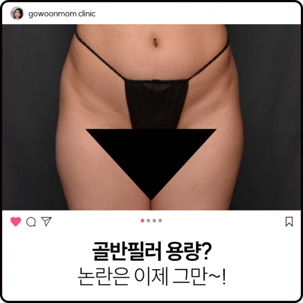 골반필러 용량? 논란은 이제 그만~!