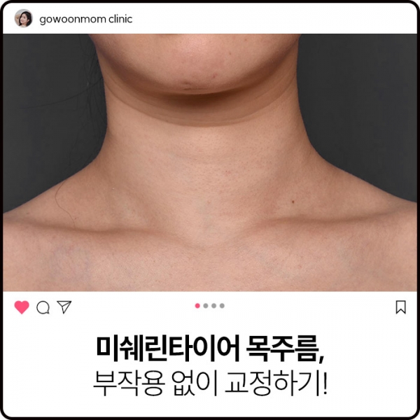 미쉐린타이어 목주름, 필러+타이트닝으로 부작용 없이 교정하기!