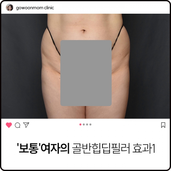 보통'여자의 골반힙딥필러 효과1