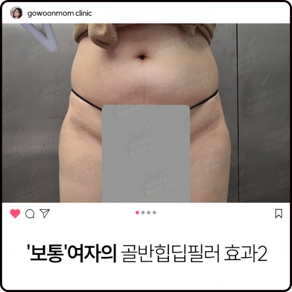 보통'여자의 골반힙딥필러 효과2