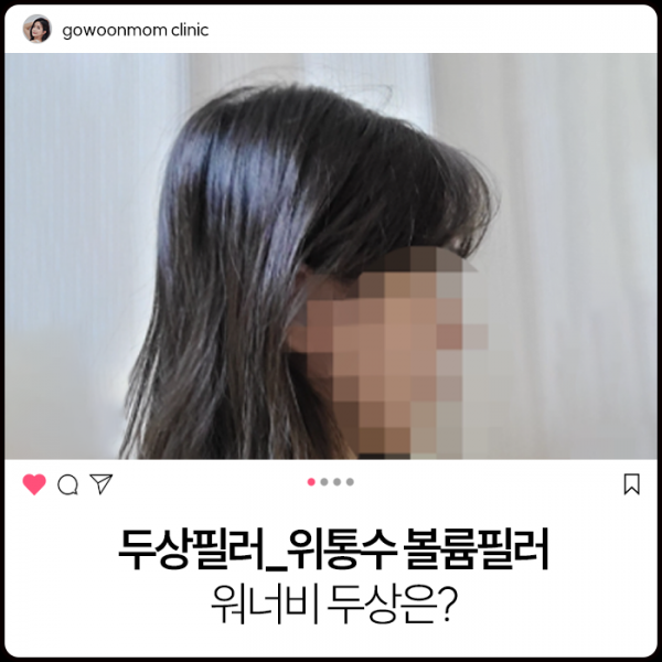 두상필러_콘헤드 정수리필러