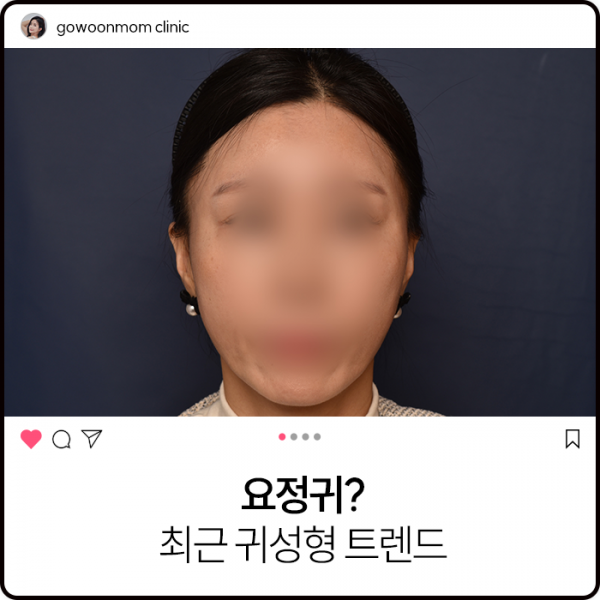 요정귀? 최근 귀성형 트렌드