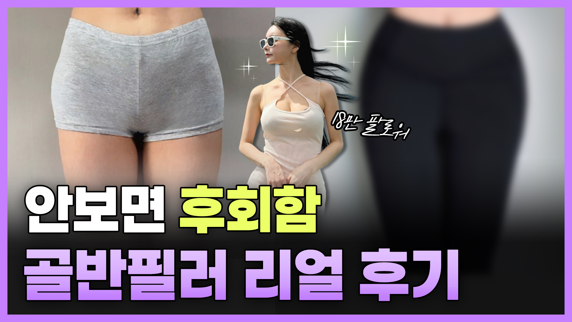 골반필러로 광명찾은 찐 후기! BJ애순님이 방문해주셨어요!♥